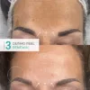 PACK DERMO PEEL RENEWAL N°3 - 6 Traitements (peeling profond peaux vieillissante-tâches de vieillesse) - Image 2