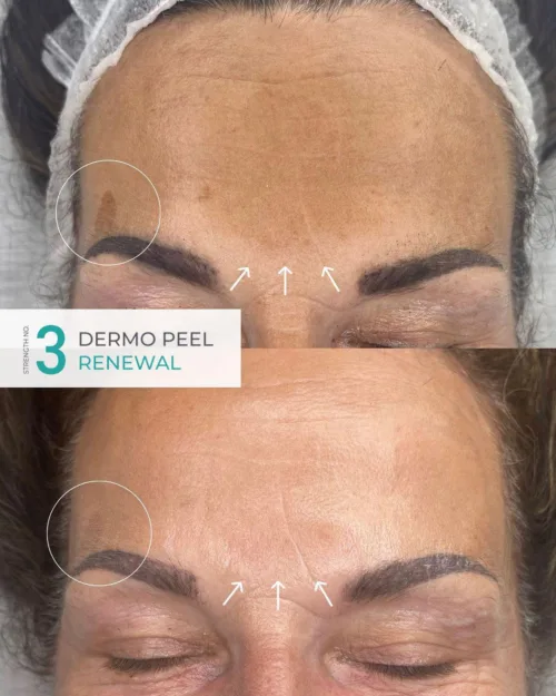 PACK DERMO PEEL RENEWAL N°3 - 6 Traitements (peeling profond peaux vieillissante-tâches de vieillesse) - Image 2
