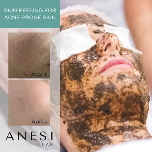 PACK DERMO PEEL CORRECTOR N°2 - 6 Traitements (peeling profond pour peaux à tendance acnéique) - Image 2